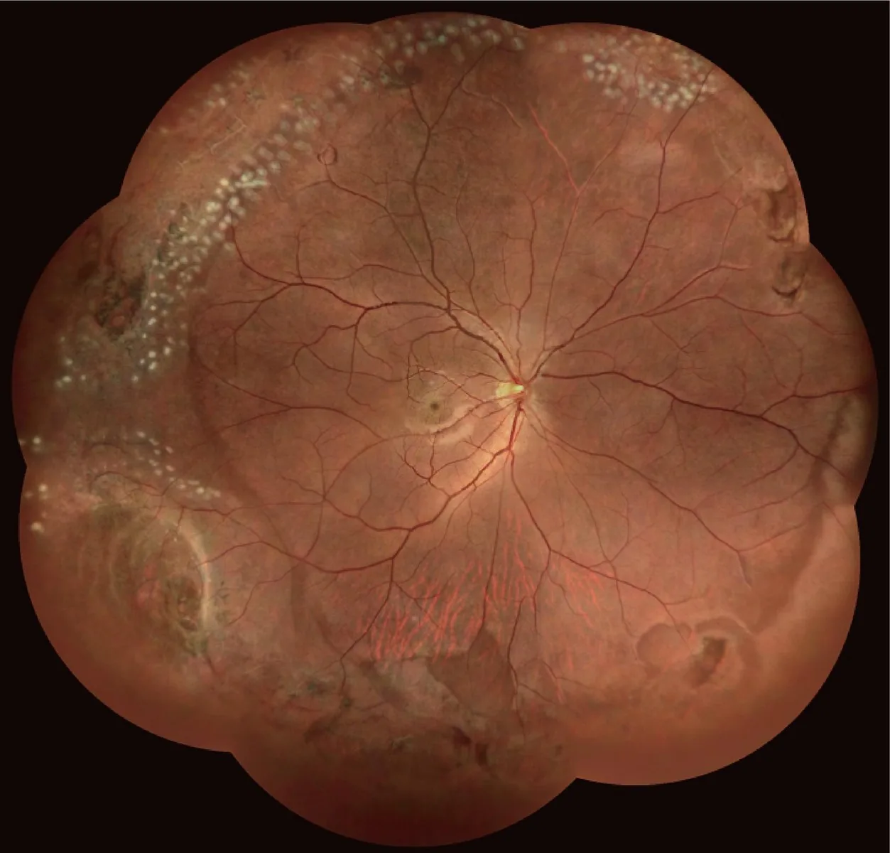 Ultra-widefield fundus mosaic acquired on the SKY